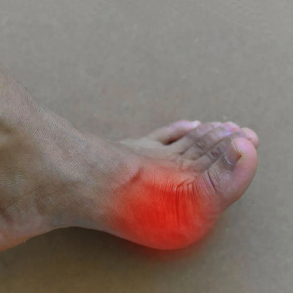Easiest Way To Relieve Bunion Pain