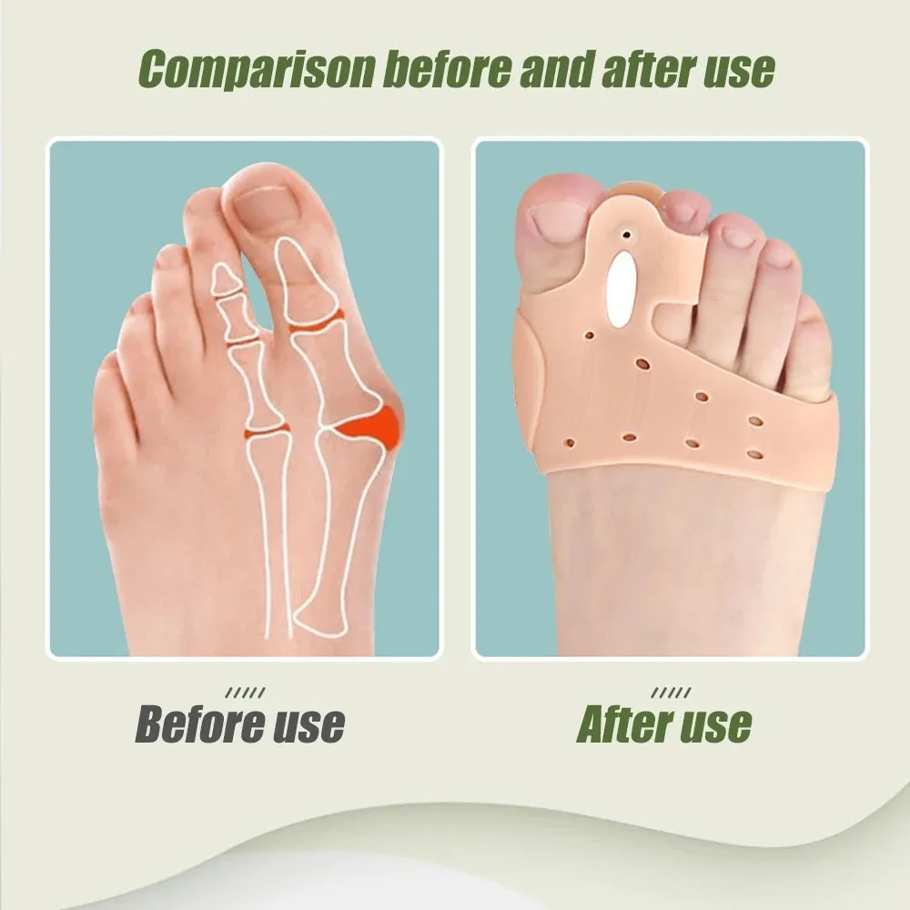 Easiest Way To Relieve Bunion Pain