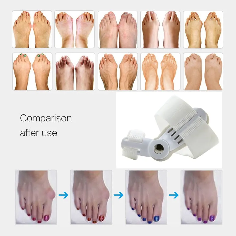 Valgus Corrector Orthopedic Bunion Corrector Realign Joint Toe